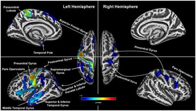 Cortical thinning in male obstructive sleep apnoea patients with excessive daytime sleepiness